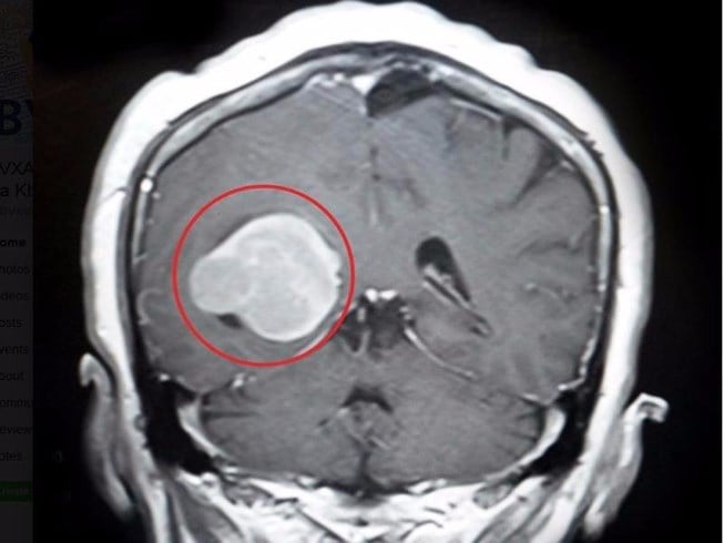 Meningiomas - Ảnh minh họa 3