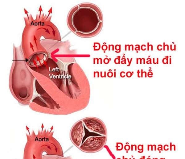 Aortic Valvular Regurgitation - Ảnh minh họa 3