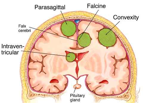 Meningiomas - Ảnh minh họa 4