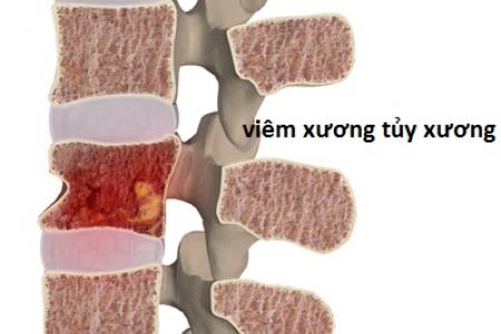 Multiple Myeloma - Ảnh minh họa 5