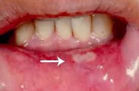 Aphthous ulcers - Ảnh minh họa 3