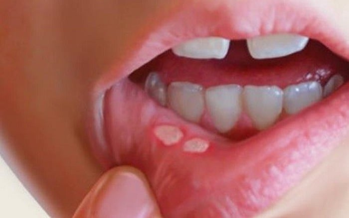 Aphthous ulcers - Ảnh minh họa 2