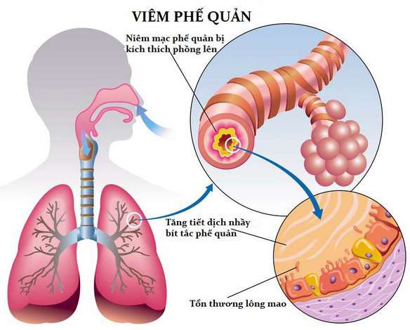 Acute bronchiolitis - Ảnh minh họa 2