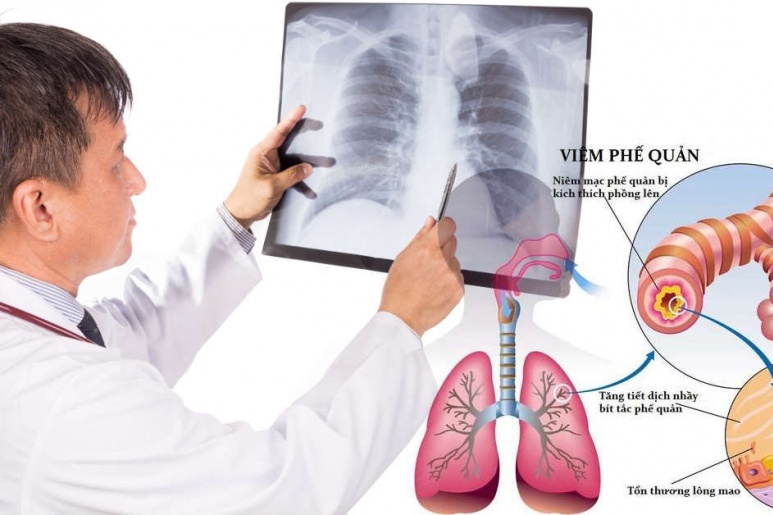 Acute bronchiolitis - Ảnh minh họa 3