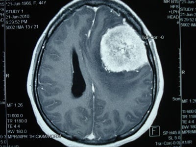 Meningiomas - Ảnh minh họa 5