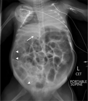 Necrotizing Enterocolitis - Ảnh minh họa 1