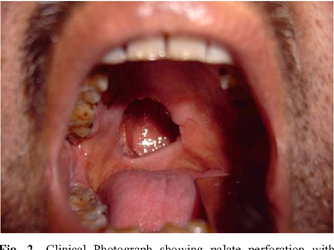 Mucormycosis - Ảnh minh họa 1