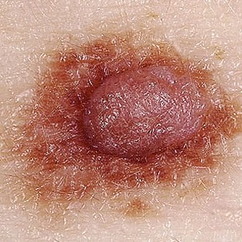 Nấm Mycosis Fungoides - Ảnh minh họa 2