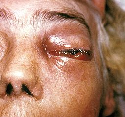 Mucormycosis - Ảnh minh họa 2