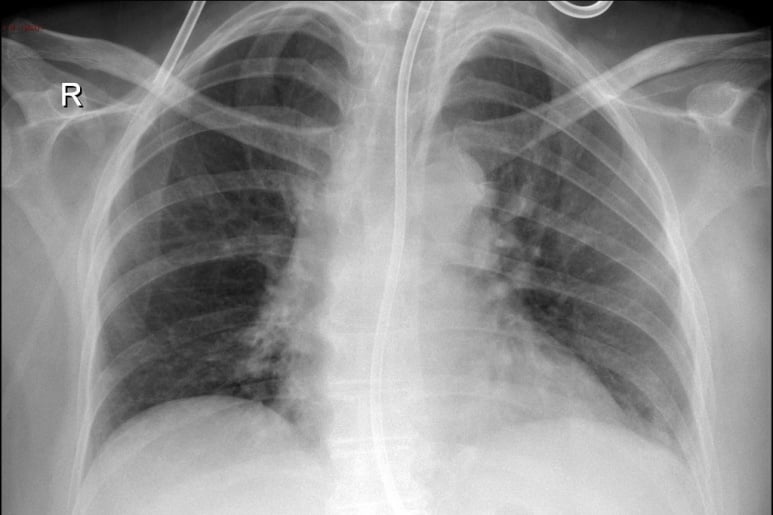 Mediastinitis - Ảnh minh họa 1