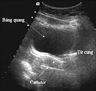 Nhi hóa tử cung - Ảnh minh họa 1