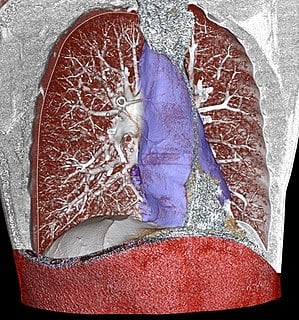 Mediastinitis - Ảnh minh họa 2