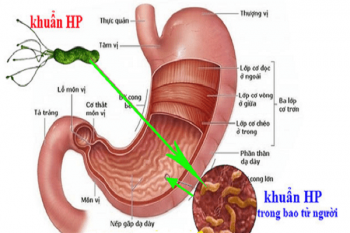 Nhiễm H. pylori (HP) - Ảnh minh họa 1