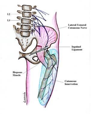 Meralgia Paresthetica - Ảnh minh họa 1