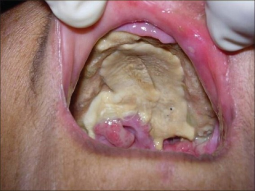 Mucormycosis - Ảnh minh họa 4