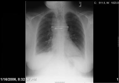 Mediastinitis - Ảnh minh họa 3