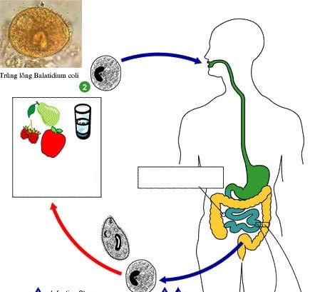 Nhiễm trùng lông Balantidium - Ảnh minh họa 2