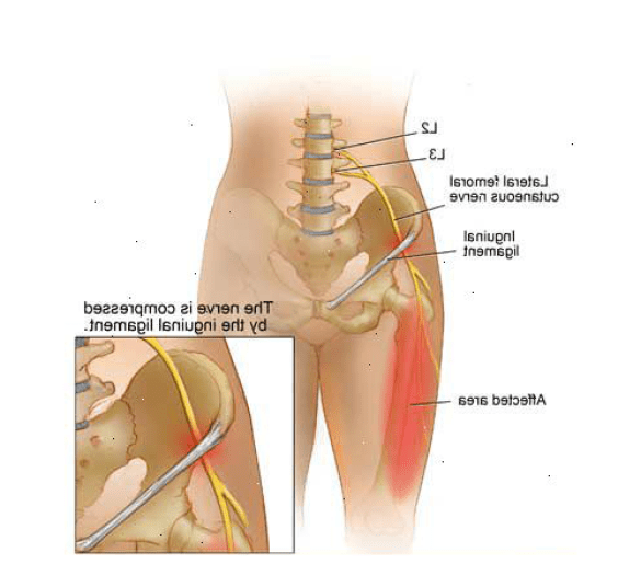 Meralgia Paresthetica - Ảnh minh họa 2