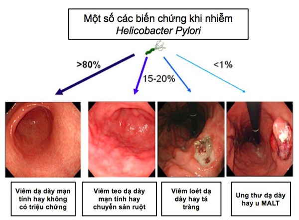 Nhiễm H. pylori (HP) - Ảnh minh họa 2