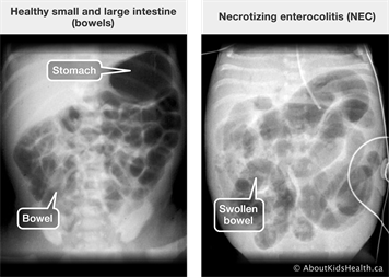 Necrotizing Enterocolitis - Ảnh minh họa 2