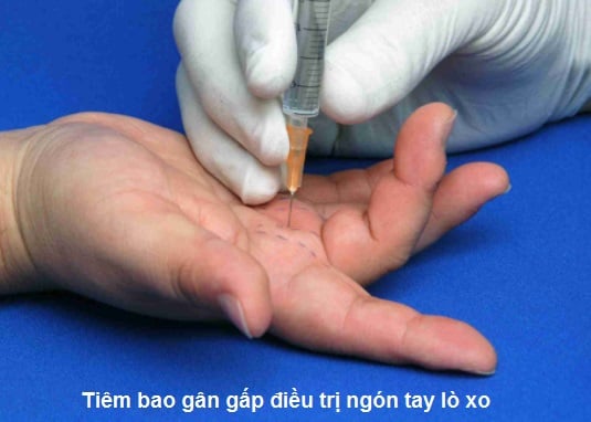 Ngón tay lò xo - Ảnh minh họa 4