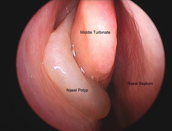 Nasal polyps - Ảnh minh họa 3