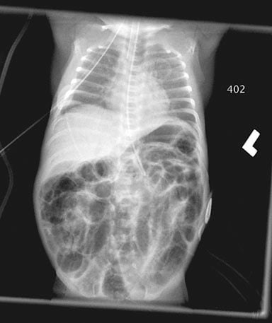 Necrotizing Enterocolitis - Ảnh minh họa 4