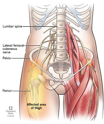 Meralgia Paresthetica - Ảnh minh họa 5