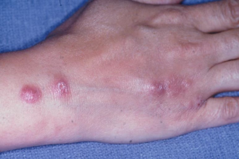 Nấm Mycosis Fungoides - Ảnh minh họa 3