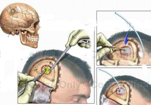 Áp-xe ngoài màng cứng - Ảnh minh họa 3