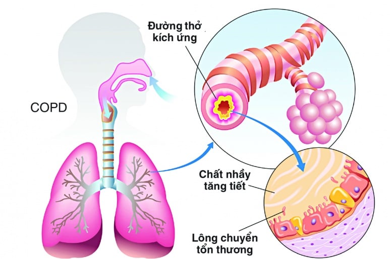 Nghẽn mạch phổi - Ảnh minh họa 1