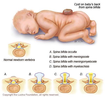 Nứt đốt sống - Ảnh minh họa 4