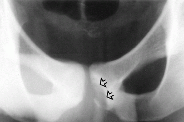 Avulsion Injuries - Ảnh minh họa 4