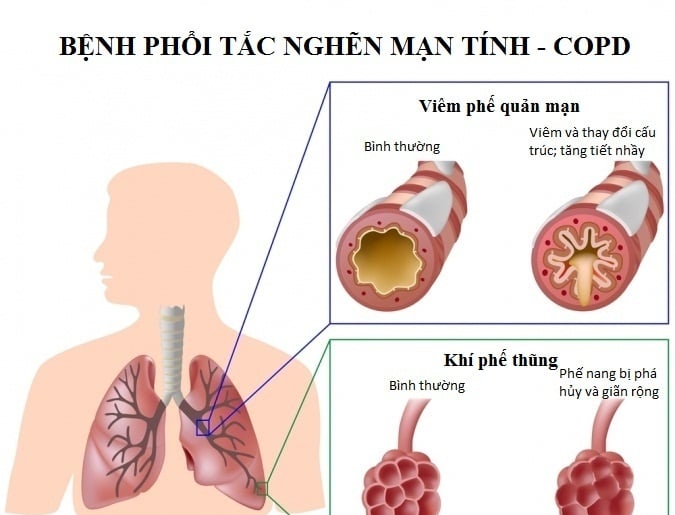 Nghẽn mạch phổi - Ảnh minh họa 2