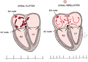 Atrial Flutter - Ảnh minh họa 3