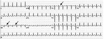 Atrial Flutter - Ảnh minh họa 2