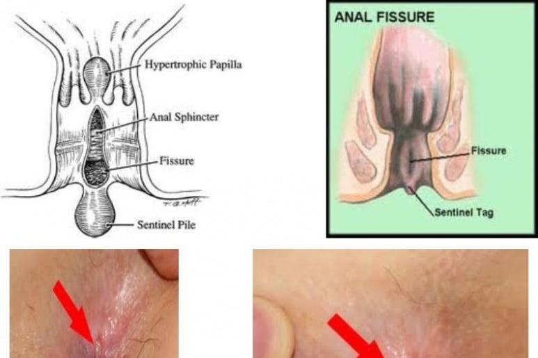 Nứt kẽ hậu môn - Ảnh minh họa 1