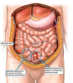 Meckel\'s Diverticulum - Ảnh minh họa 2