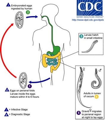 Nhiễm giun kim - Ảnh minh họa 2