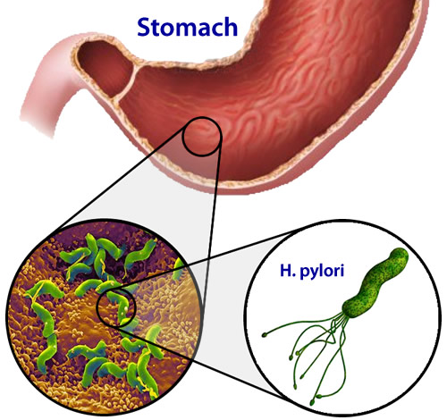 Nhiễm H. pylori (HP) - Ảnh minh họa 3