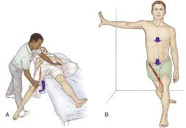 Meralgia Paresthetica - Ảnh minh họa 3