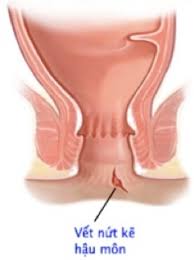 Nứt kẽ hậu môn - Ảnh minh họa 2