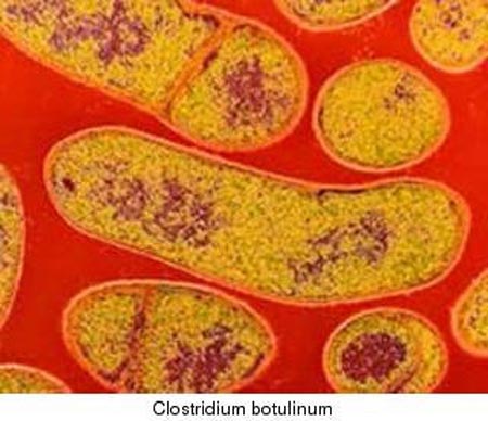 Nhiễm vi khuẩn Clostridium botulinum - Ảnh minh họa 5