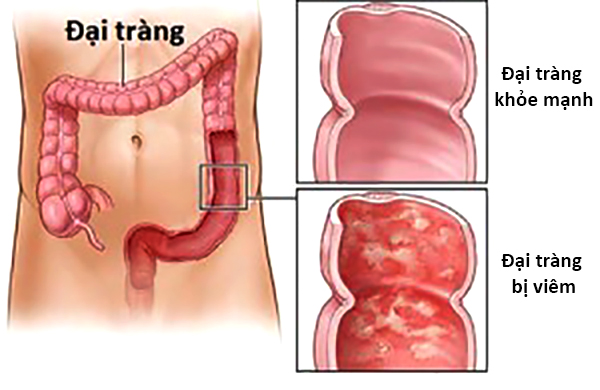 Amebiasis - Ảnh minh họa 3