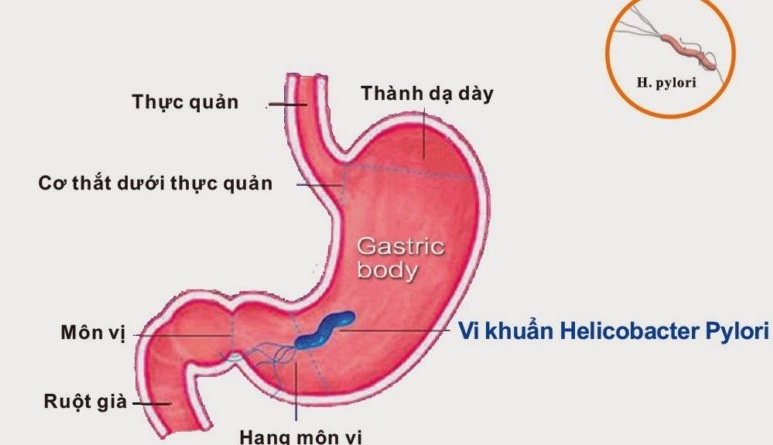 Nhiễm H. pylori (HP) - Ảnh minh họa 4