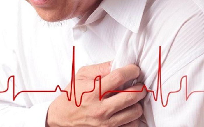 Arrhythmia Palpitations - Ảnh minh họa 2