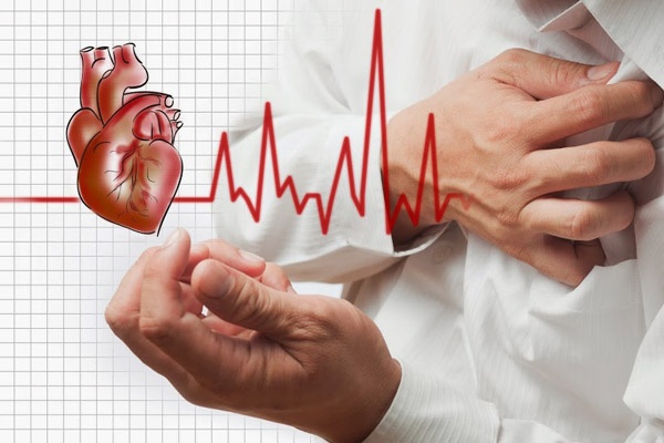 Arrhythmia Palpitations - Ảnh minh họa 4