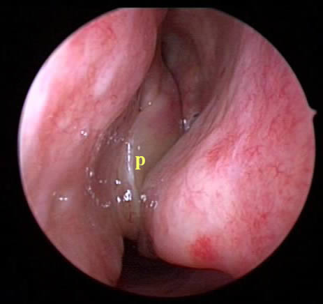 Nasal polyps - Ảnh minh họa 4