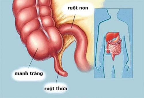 Nghẽn ruột - Ảnh minh họa 2
