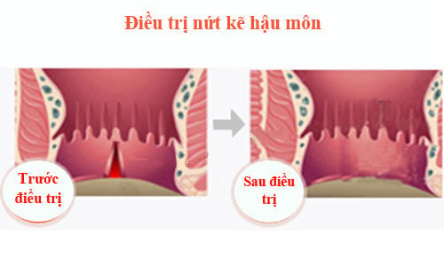 Nứt kẽ hậu môn - Ảnh minh họa 5